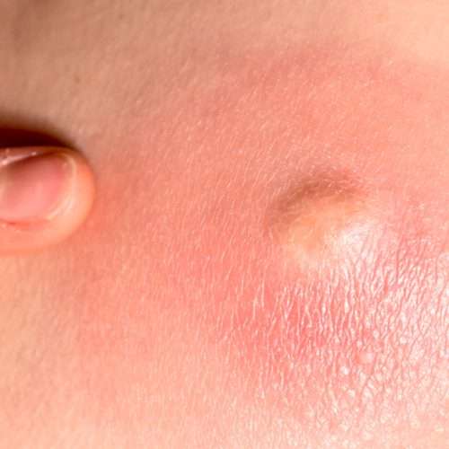 Nodule (Type Of Acne) Treatment In Lahore, Pakistan