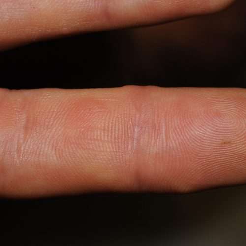 Papules (Red Bumps On Skin) Treatment In Lahore, Pakistan at Institute Cosmetique.