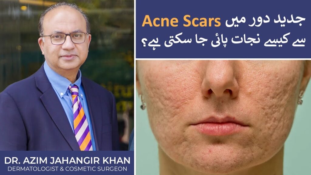 Acne Scar Treatment in Lahore